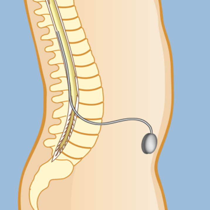Spasticity Strokeot